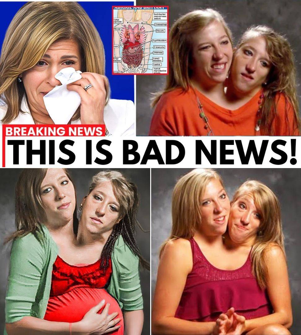 Mother of the Conjoined Twins Confirms the Terrible Rumors Are True